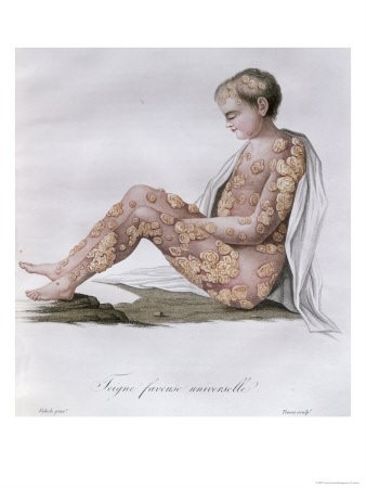 imagem antiga corpo com pustulas