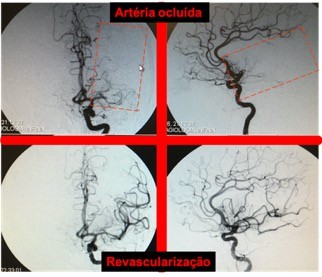 Imagem, AVC da artéria cerebral média esquerda, antes e após terapêutica de revascularização.